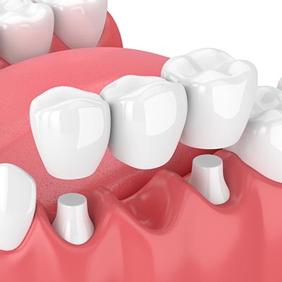 Dental Bridge | Sarcee Dental | NW Calgary | General and Family Dentist