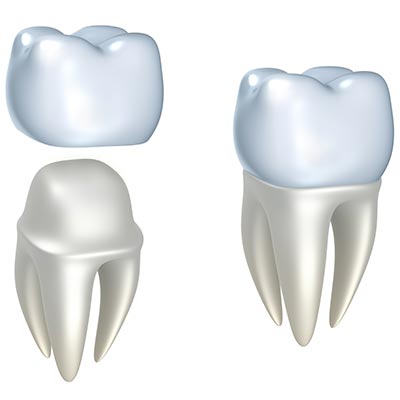 Dental Crown | Sarcee Dental | NW Calgary | General and Family Dentist