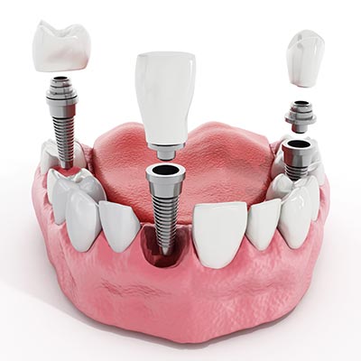 Dental Implants | Sarcee Dental | NW Calgary | General and Family Dentist