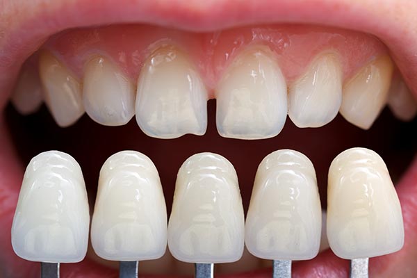 Porcelain Veneers | Sarcee Dental | NW Calgary | General and Family Dentist