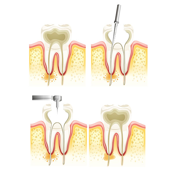 Root Canal | Sarcee Dental | NW Calgary | General and Family Dentist