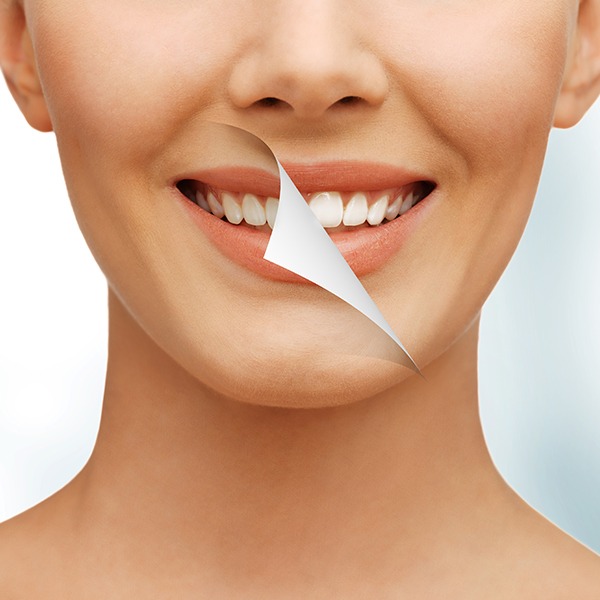 Teeth Whitening | Sarcee Dental | NW Calgary | General and Family Dentist