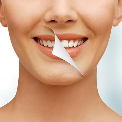 Teeth Whitening | Sarcee Dental | NW Calgary | General and Family Dentist