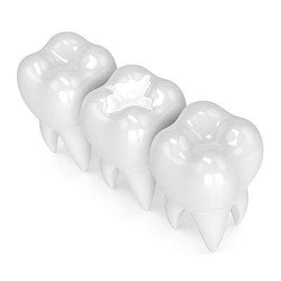 White Fillings | Sarcee Dental | NW Calgary | General and Family Dentist